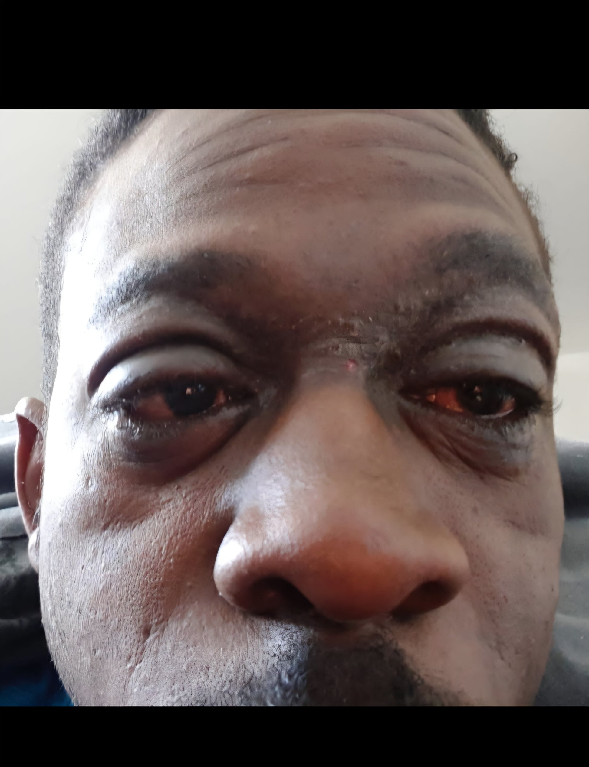 Before the dry skin treated with natural skincare, showing broken skin